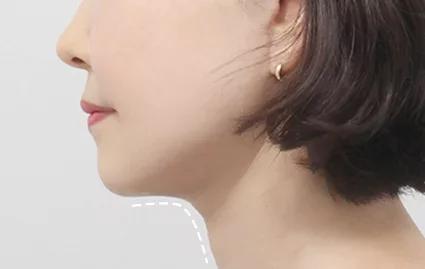 手术后 2个月