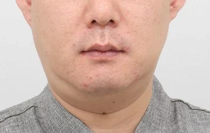 手术前
