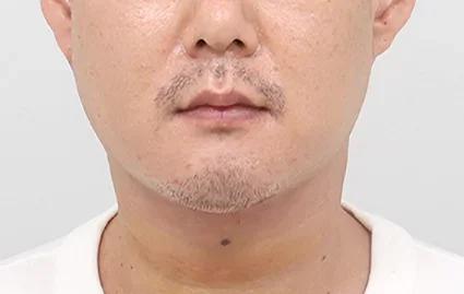 手术后 1周