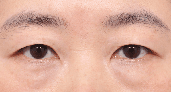 眼瞼整體下垂
需要做上眼瞼手術的眼睛
