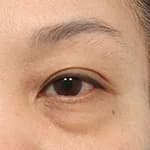 上眼瞼拉提