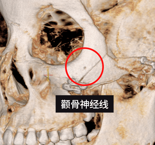 L字截骨術