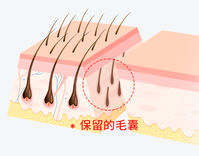 用45度斜线切开保留毛囊