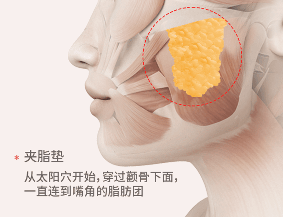 更精緻，去除頰脂墊