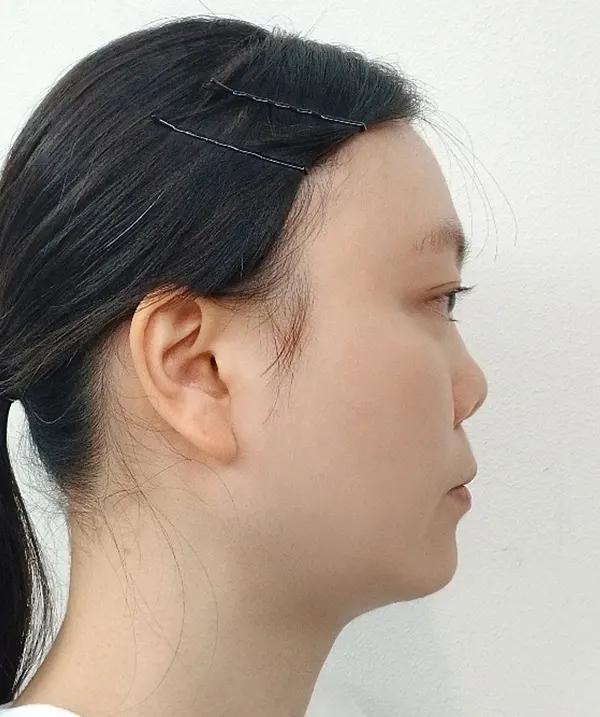 Before and after surgery side view