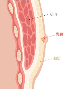 Gynecomastia surgery