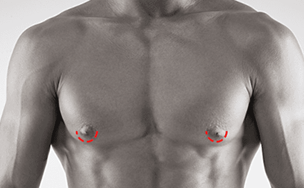 Gynecomastia surgery