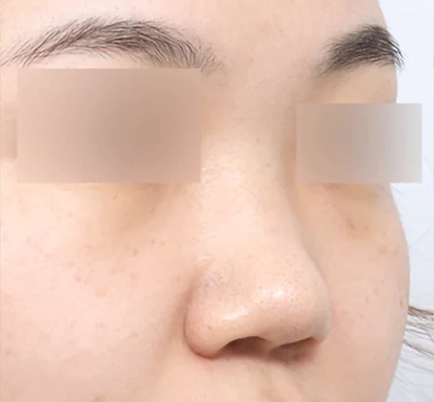 自然的鼻樑 before