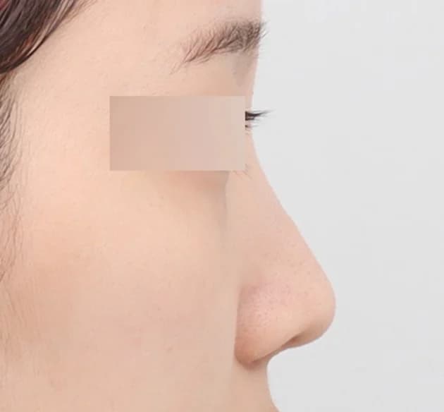 精緻客製鼻部線條 before