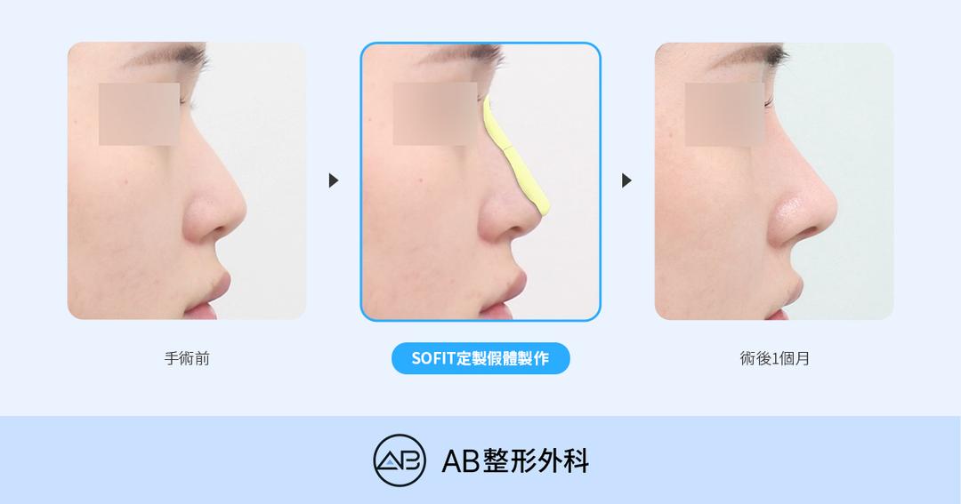 SOFIT 3D客製化鼻模和一般隆鼻有什麼不同？哪些情況適合客製化鼻模？