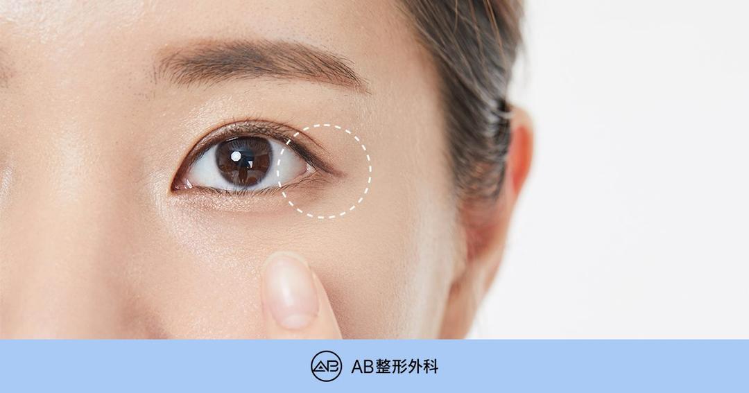 韓國開眼尾會黏回去嗎？風險與適合眼型｜AB整形外科
