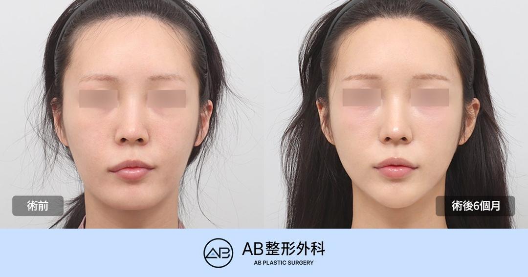 韓國削骨可以打造明星般的小臉嗎？面部輪廓手術、顴骨與下顎角一次解析