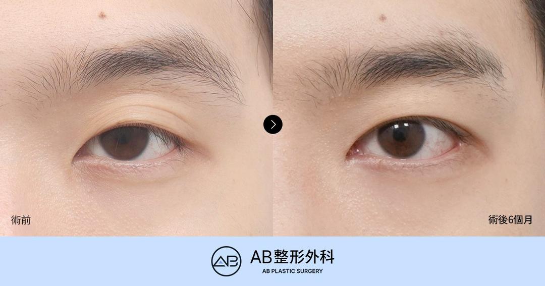 韓國男士雙眼皮怎麼做自然？男士眼型矯正、開眼角與恢復期案例解析