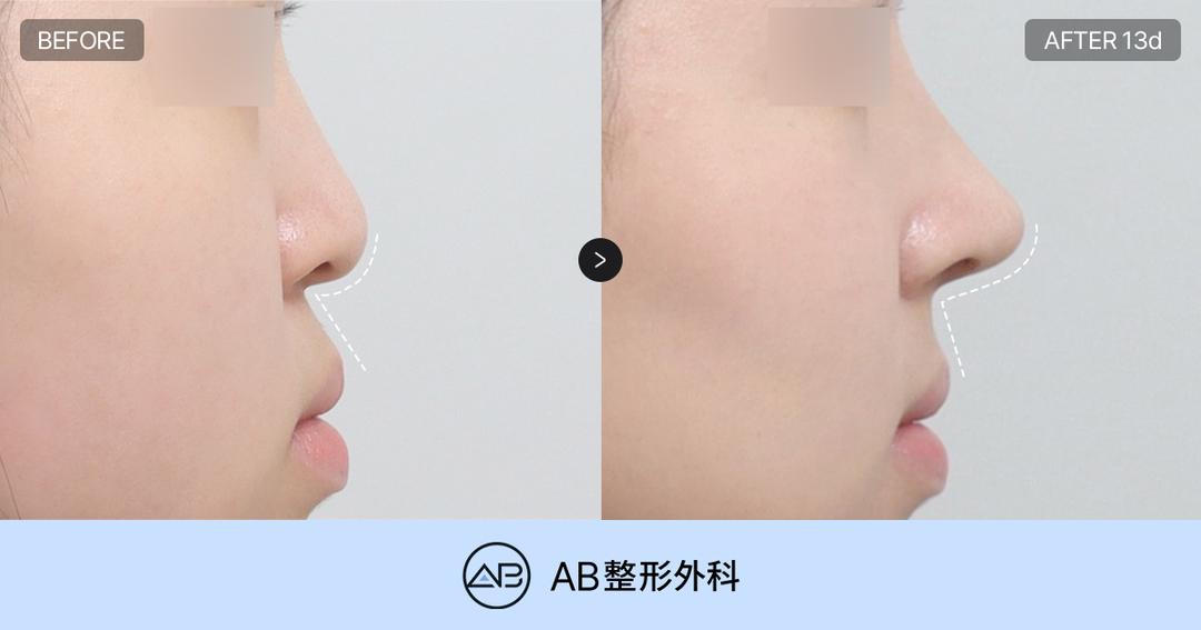 韓國鼻尖整形為什麼要看鼻小柱和鼻唇角？醫師解析自然鼻型的關鍵