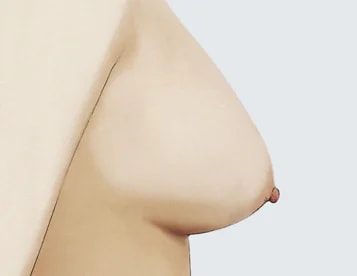 1 級（輕度下垂）