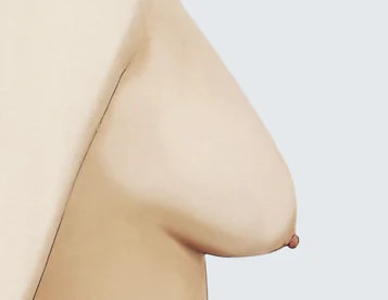 2級（中度下垂）