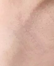 2个月后，腋下部位