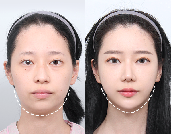 考慮整個面部的個人定製式設計