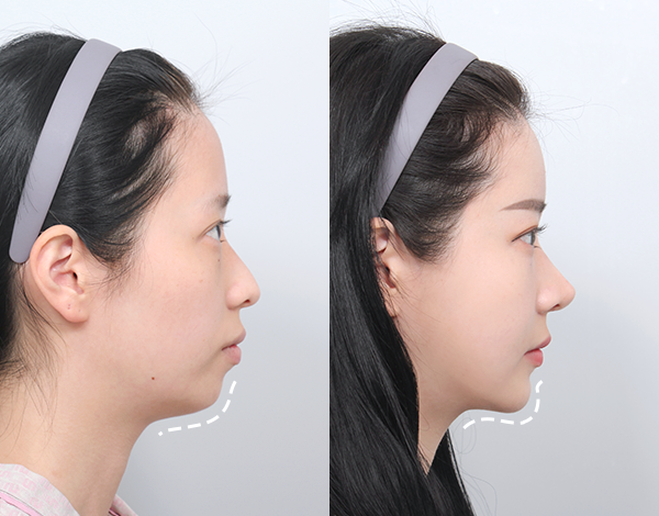 考慮整個面部的個人定製式設計