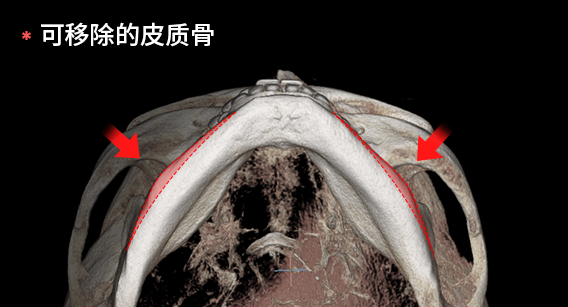為獲得正面效果切除皮質骨