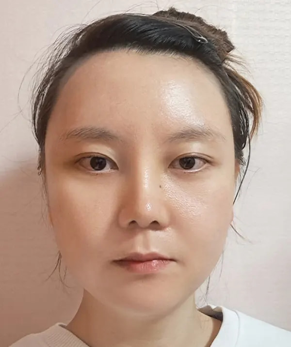 Before and after surgery front view