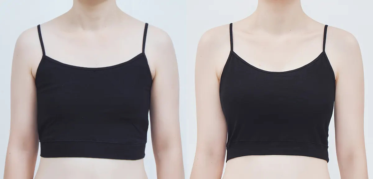 Before and after surgery