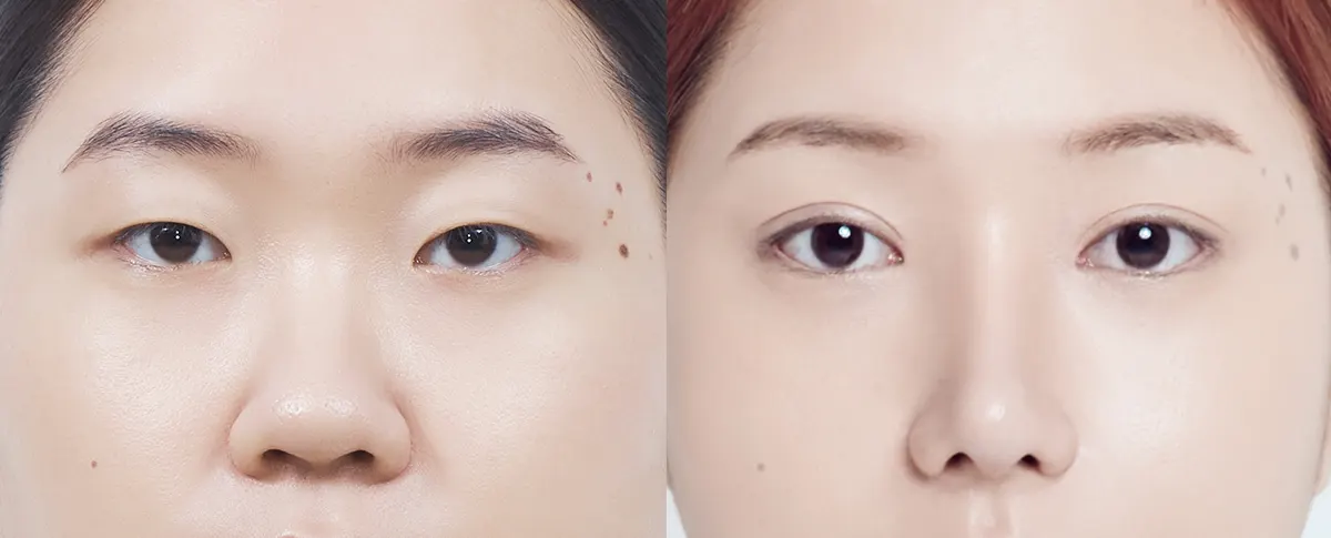 맥미걸 악플콜렉터 수술 전후 의학 사진