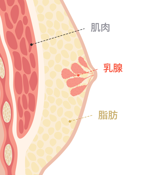 Gynecomastia surgery