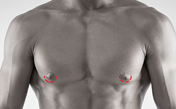 Gynecomastia surgery
