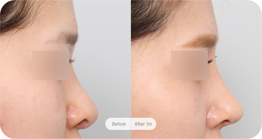 revision-rhinoplasty