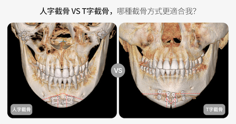韓國下巴整形怎麽選？T截骨 vs ㅅ截骨區別解析｜韓國輪廓手術前必看（AB整形外科）
