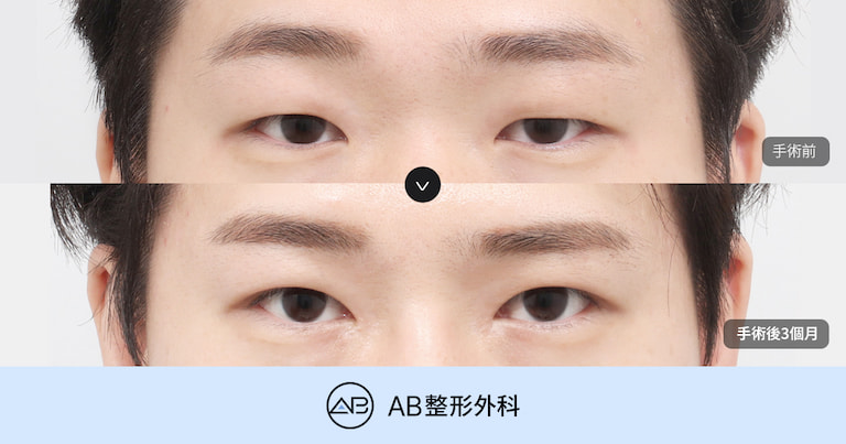男性大小眼矯正怎麼做？韓國江南AB整形外科解析自然型男性眼部矯正手術方法
