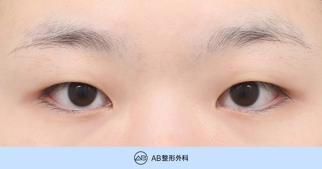 韓國單眼皮雙眼皮手術｜自然雙眼皮＋眼型矯正＋去脂肪＋開眼角一次解析｜AB整形外科