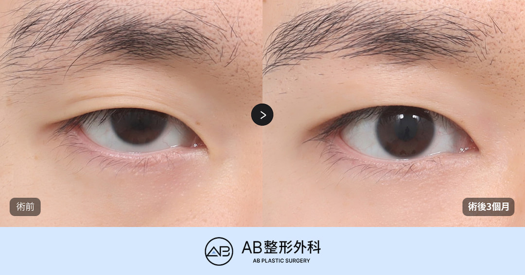 韓國男生雙眼皮怎麼做才自然？男性眼綜合、眼型矯正完整解析
