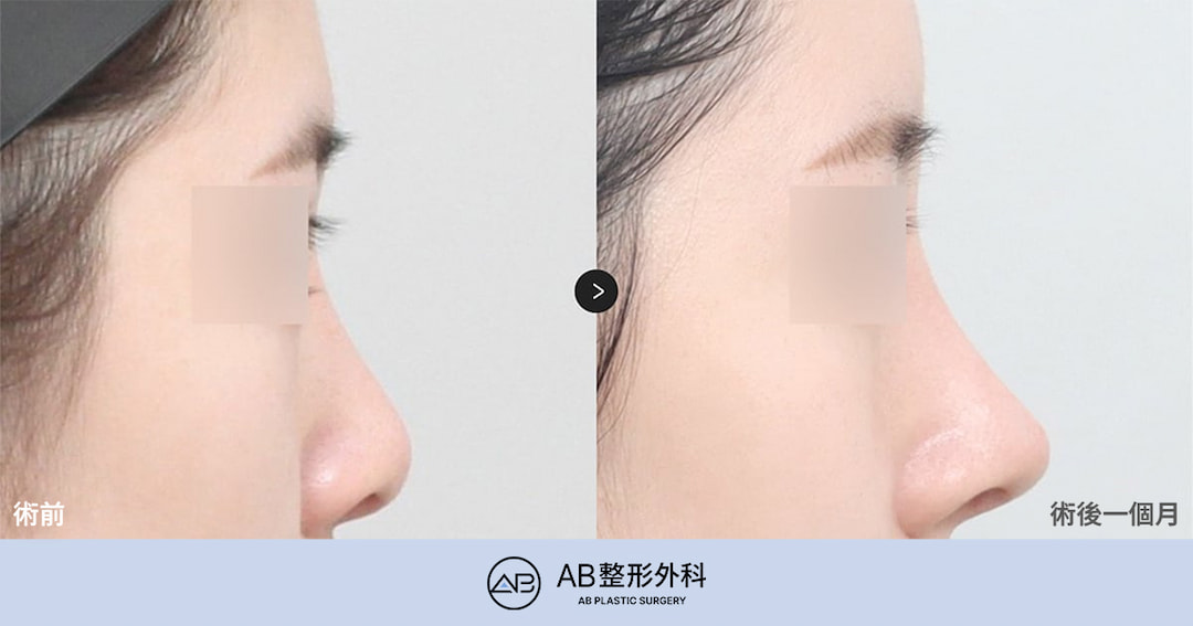 韓國鼻修復哪家醫院好？鼻修復手術前一定要確認這5個標準｜韓國AB整形外科李東翰院長解析