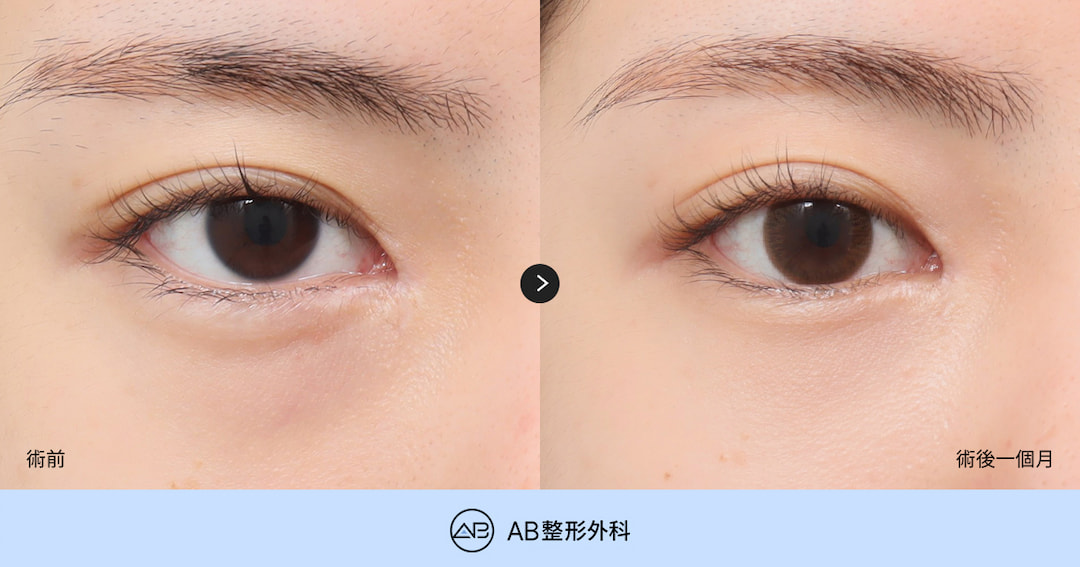 韓國眼袋手術為什麼越來越多人選擇眼下脂肪重置？
