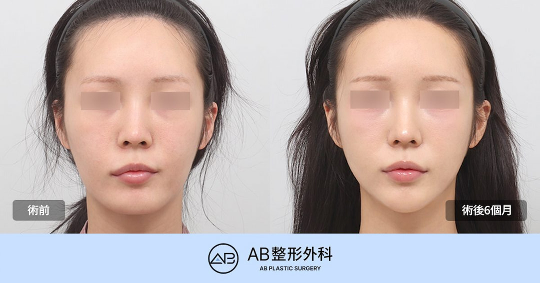 韓國削骨可以打造明星般的小臉嗎？面部輪廓手術、顴骨與下顎角一次解析