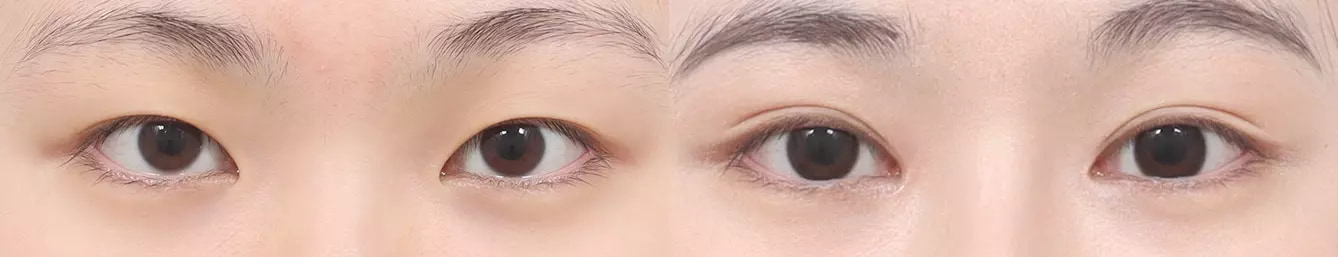 ABC point before and after case 3