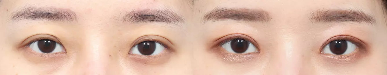 Eye line before and after case 3