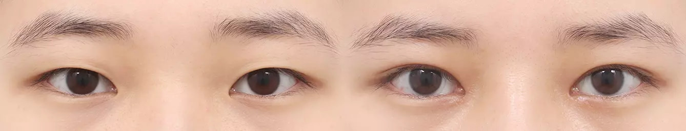 Double eyelid before and after case 5