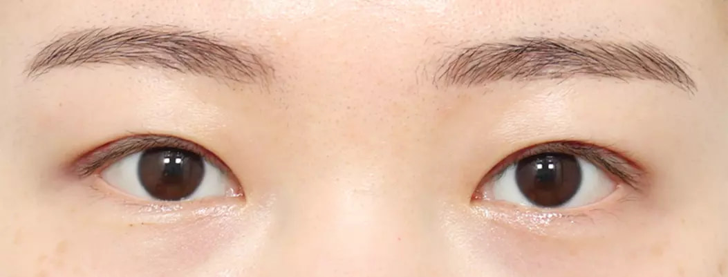 手術後2天自然黏連雙眼皮