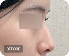 Before and after 1-1