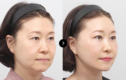before & after