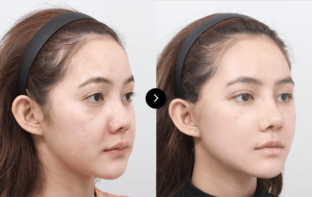 before & after