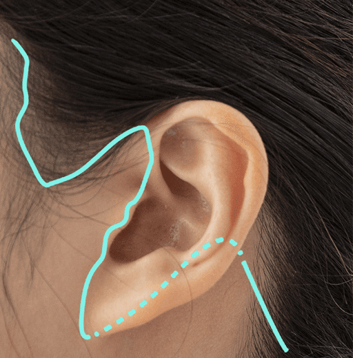 incision methods