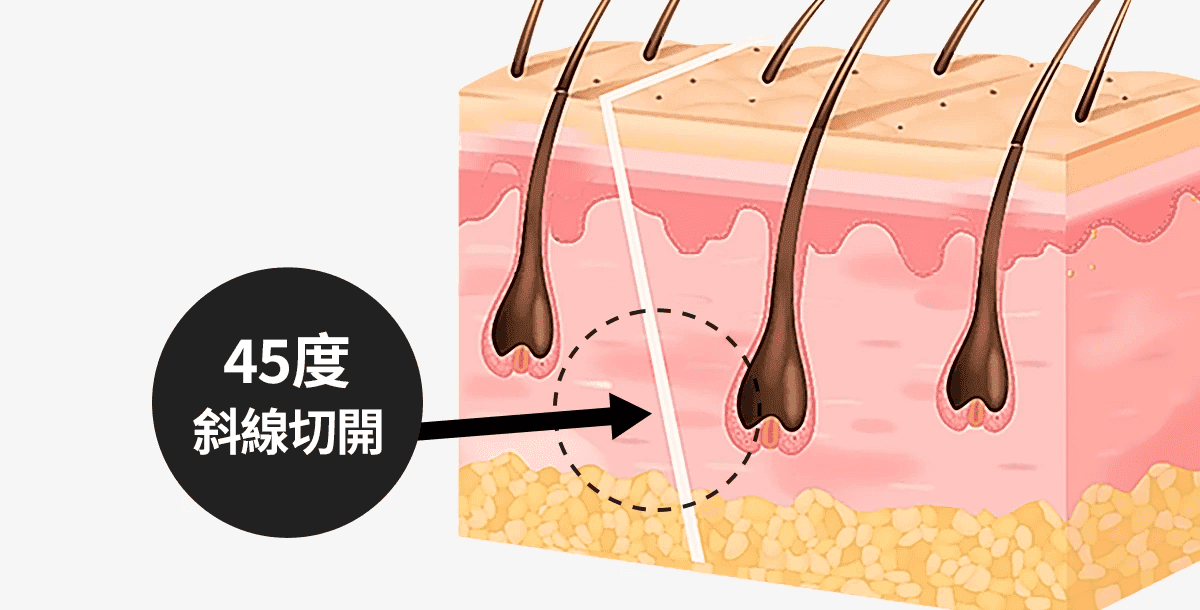 45-degree diagonal incision