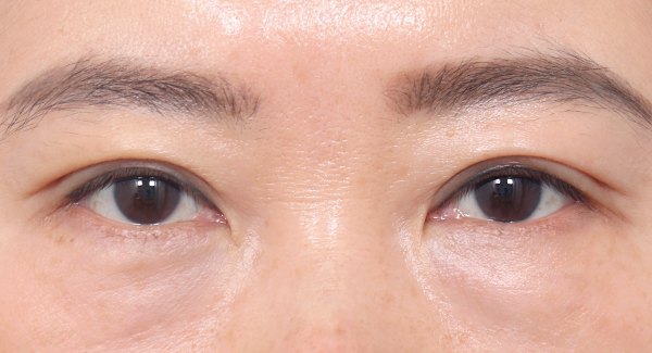 牢牢固定1个月后的样子
不开,维持的非常自然的弧度