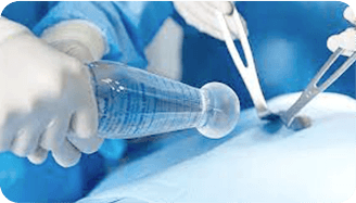 AB surgery