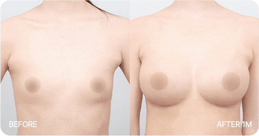 Ab Surgery
