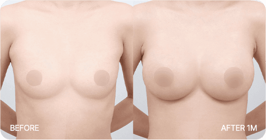 Ab Surgery